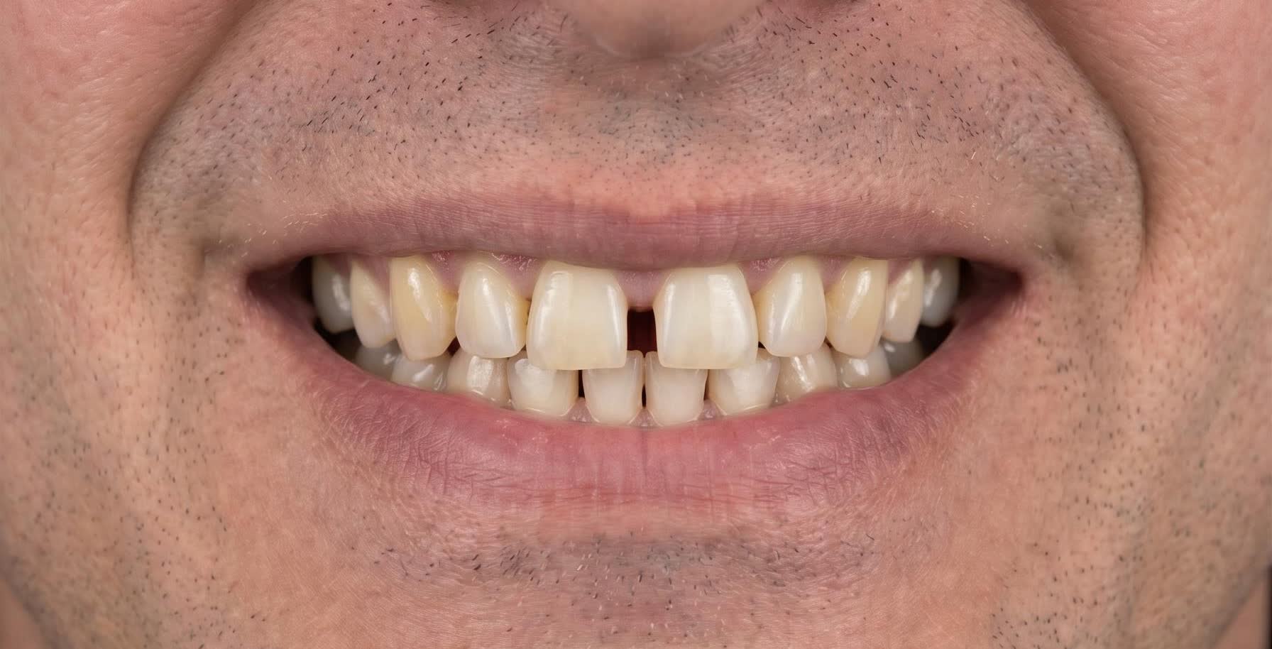 Sonrisa antes del tratamiento