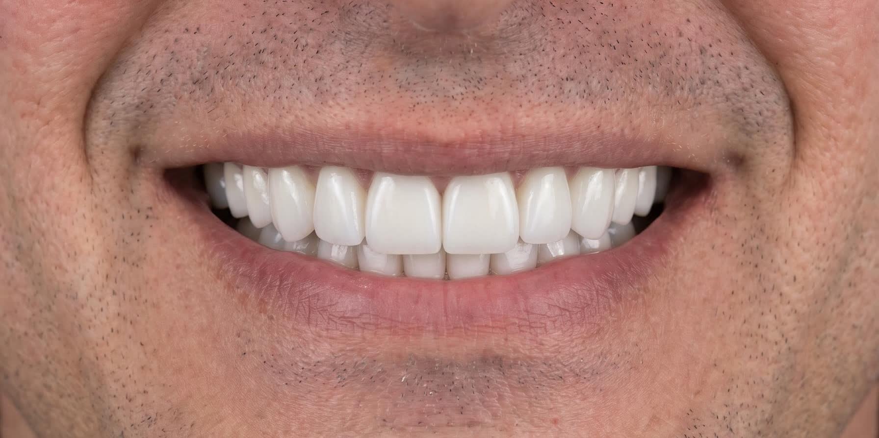 La misma sonrisa después del tratamiento